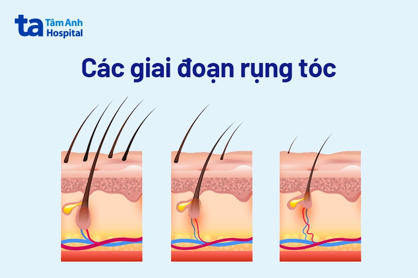 Rụng tóc nhiều là bệnh gì? 18 nguyên nhân gây nên và cách khắc phục