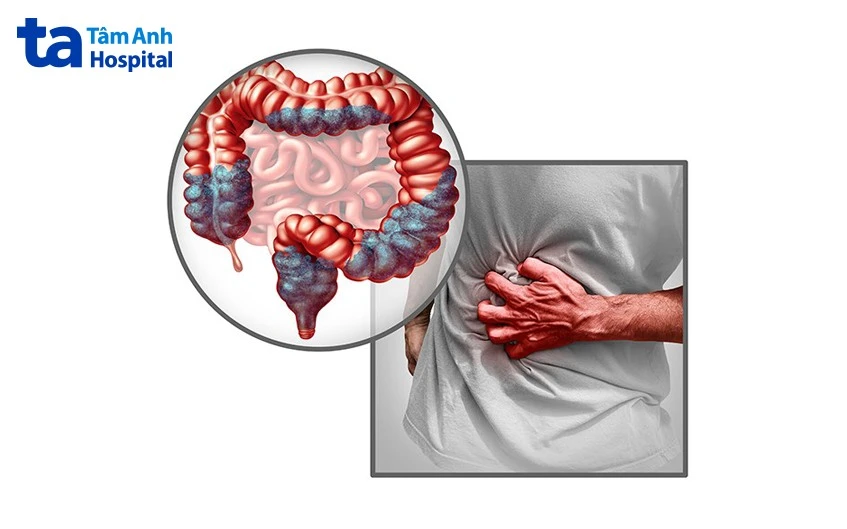 Đau quặn bụng: Nguyên nhân, dấu hiệu và cách phòng ngừa