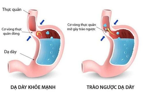 Các vấn đề thường gặp ở thực quản