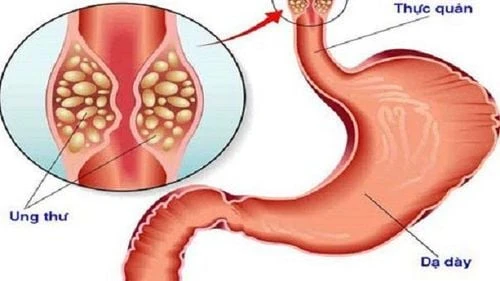 Các vấn đề thường gặp ở thực quản