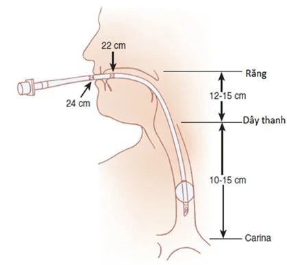 Kỹ Thuật Đặt Nội Khí Quản Cấp Cứu