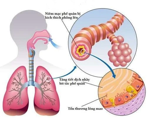 Viêm phế quản có lây không?