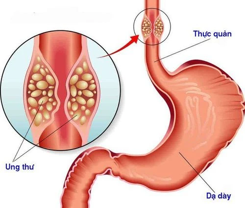 Hiểu Biết Về Viêm Thực Quản Trào Ngược Độ A