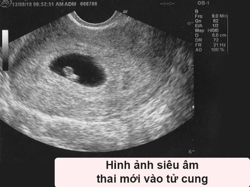 Dấu hiệu thai vào tử cung là gì? Cách nhận biết và thử que thử thai