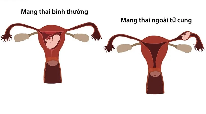 Tình trạng ra khí hư màu hồng nhạt có nguy hiểm không?