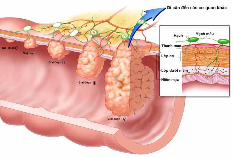 Ung thư thực quản giai đoạn cuối: Triệu chứng, hướng điều trị và tiên lượng