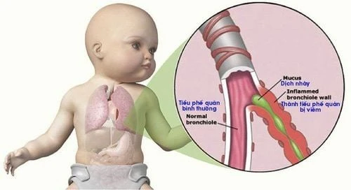 Phác đồ điều trị viêm tiểu phế quản cấp ở trẻ